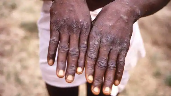 This Country Becomes First In The World To Introduce Compulsory Monkeypox Quarantine | Mint